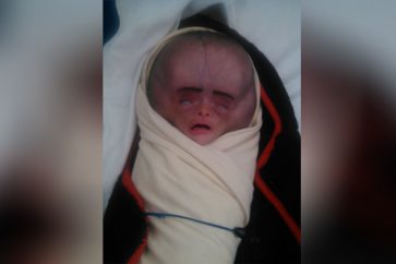 Yémen : Malformation des nouveaux nés suite aux armes prohibées de la coalition