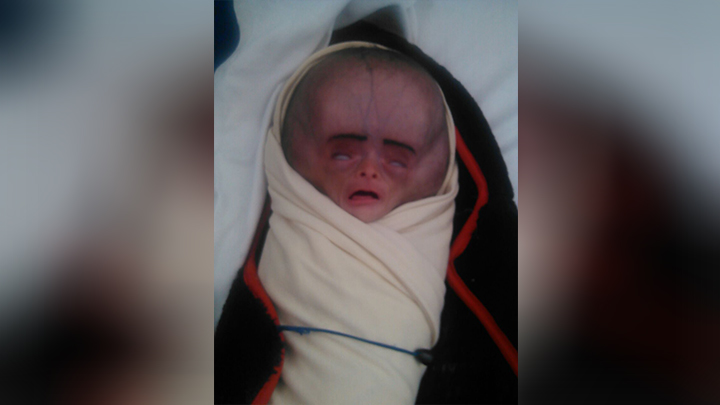 Yémen : Malformation des nouveaux nés suite aux armes prohibées de la coalition