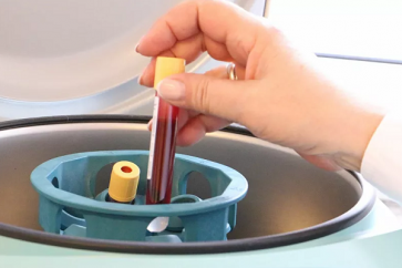 Des chercheurs chinois affirment avoir établi un lien entre un groupe sanguin et le risque d’infection au coronavirus